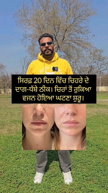 ਸਿਰਫ਼ 20 ਦਿਨ ਵਿੱਚ ਚਿਹਰੇ ਦੇ ਦਾਗ-ਧੱਬੇ ਠੀਕ। ਚਿਰਾਂ ਤੋਂ ਰੁਕਿਆ ਵਜਨ ਹੋਇਆ ਘਟਣਾ ਸ਼ੁਰੂ। Melasma reversal case